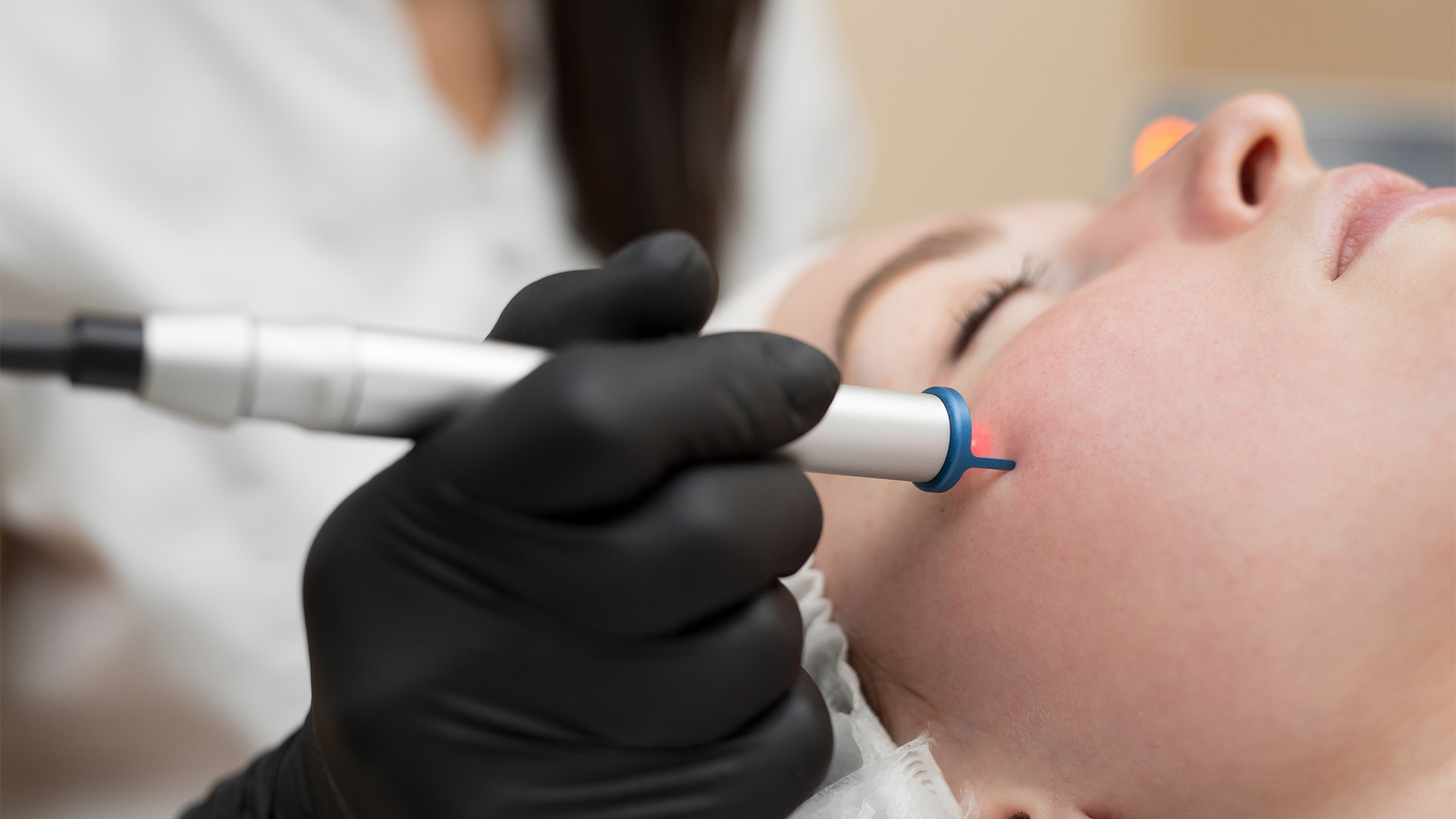 เลเซอร์รักษาหลุมสิว